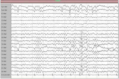 Adult-onset Krabbe disease presenting with progressive myoclonic epilepsy and asymmetric occipital lesions: A case report